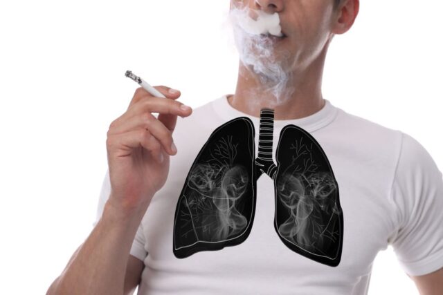 Smoking and lung cancer